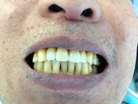 Dental-Implants-After Dental Implants - After