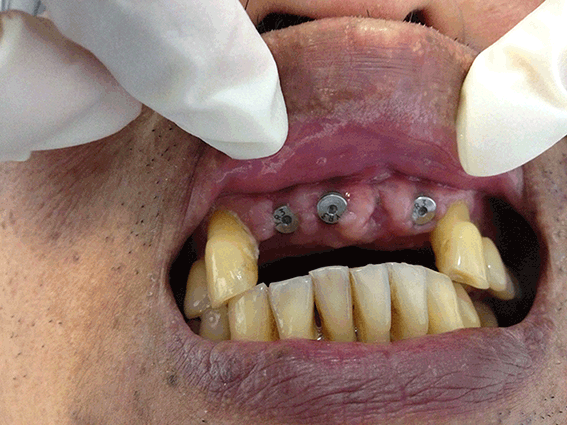 DentalImplants-Before Dental Implants - Before
